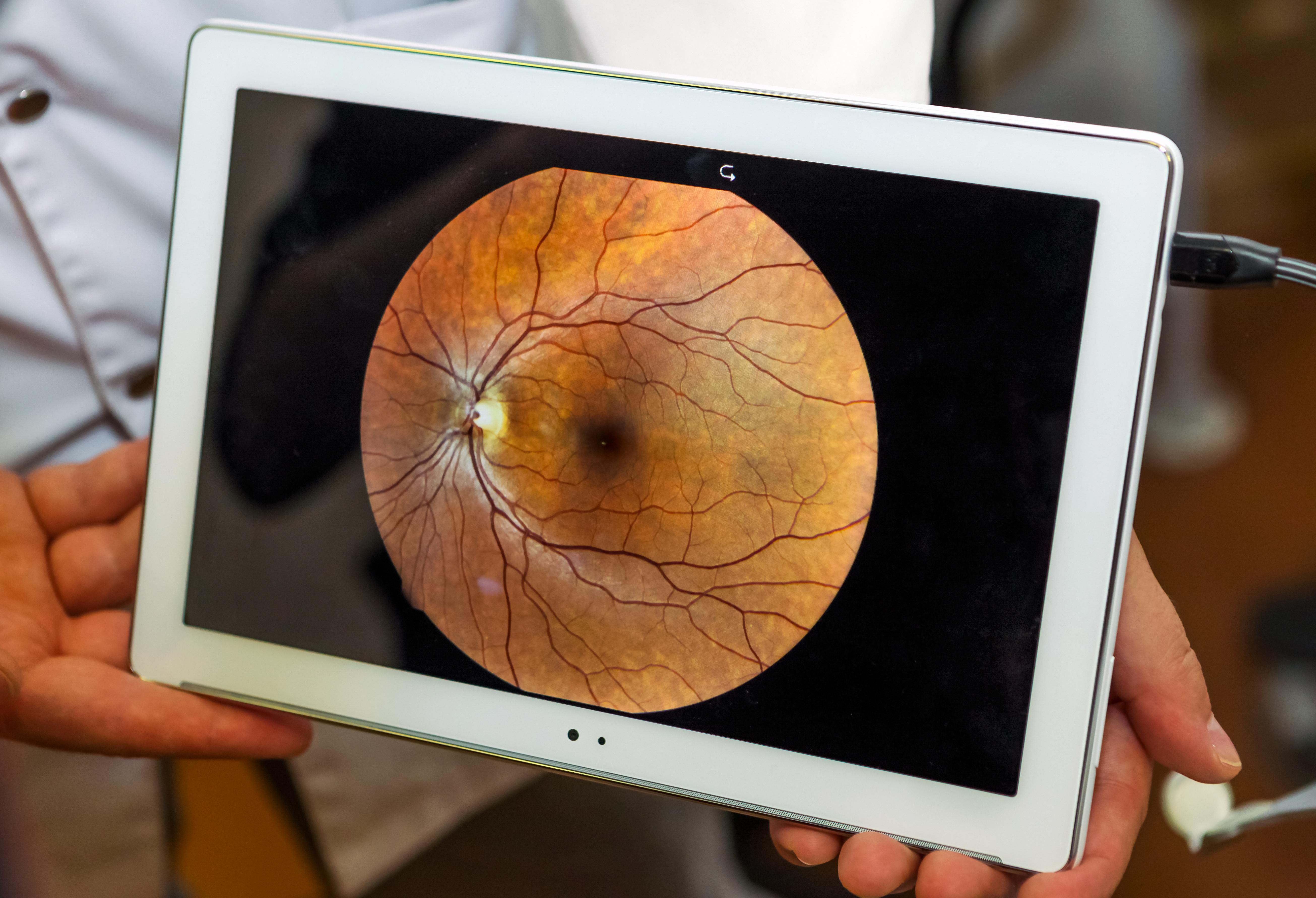Retinal detachment in children