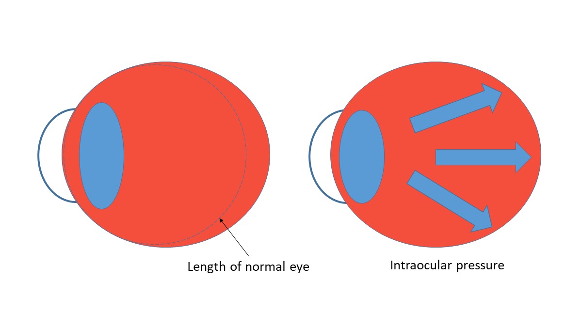 Myopic-D-like-IOP-image-1.jpg