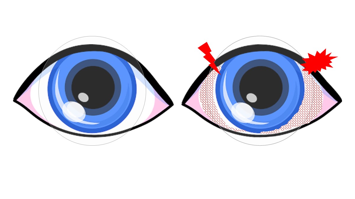 Kids-CLs-dry-eye-BV.jpg