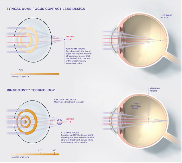 Contact Lens Technology