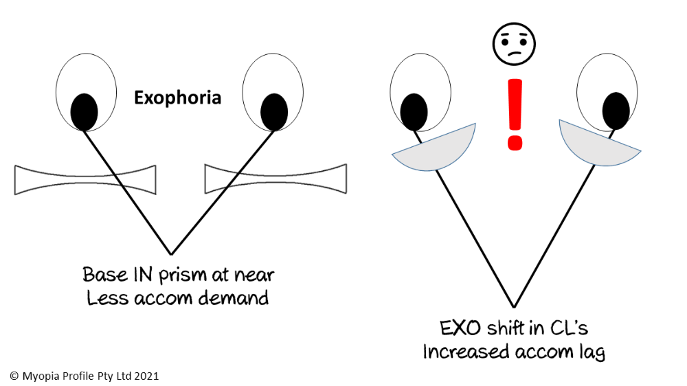 BV specs to CLs exo myope.png